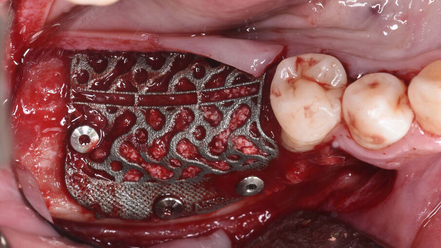 Fig. 5_Visione intra-operatoria della griglia riempita con un mix di osso autologo particolato prelevato dal ramo mandibolare e osso eterologo in rapporto 1:1 e fissata mediante 3 viti in titanio di 1.4 mm di diametro e dopo inserimento di due impianti osteointegrati.
