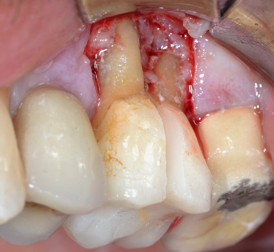 Fig. 5 - Separazione delle radici effettuata mediante fresa diamantata.