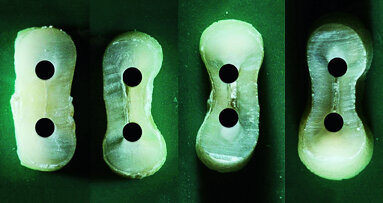 Dentinal defects after root canal preparation