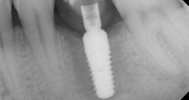 Odložená implantace a augmentace – měření stability implantátu pomocí integrovaného modulu ISQ