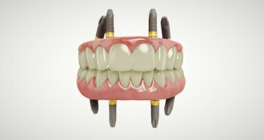 New study findings on Xeal and TiUltra surfaces with All-on-4 treatment concept