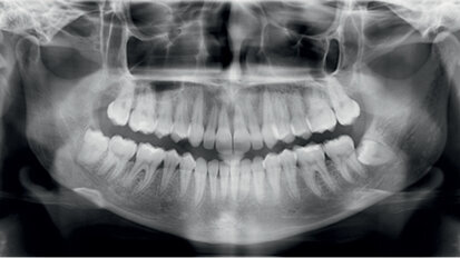Distalizace horních molárů pomocí alignerů a cyklických sil