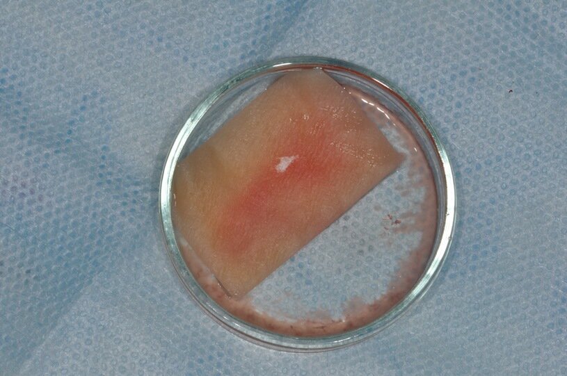 Ryc. 6_Mucograft nasączony iPRF.