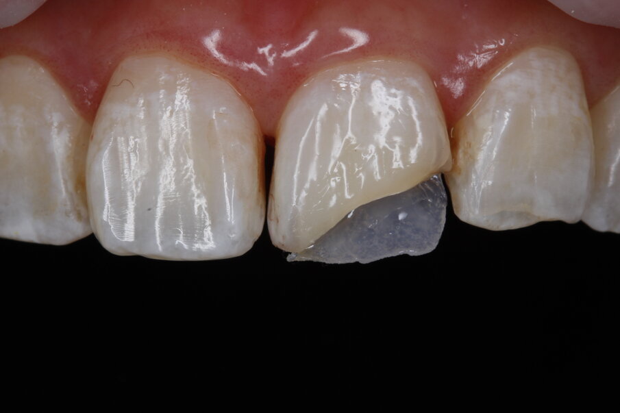 Fig 7: Palatal shell with Beautifil II Enamel T