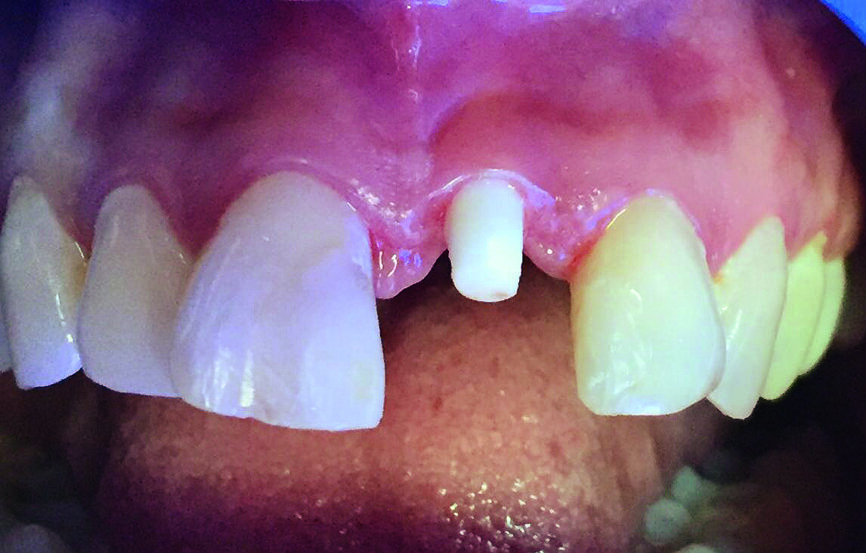 Fig. 4 : Stade de la cicatrisation après quatre mois