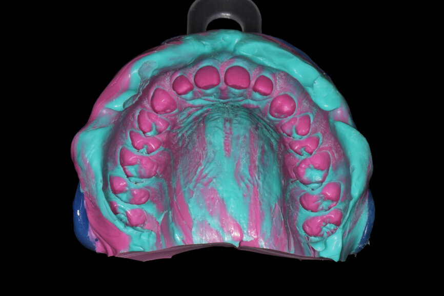 Fig. 15: Maxillary and mandibular impressions for the diagnostic models.
