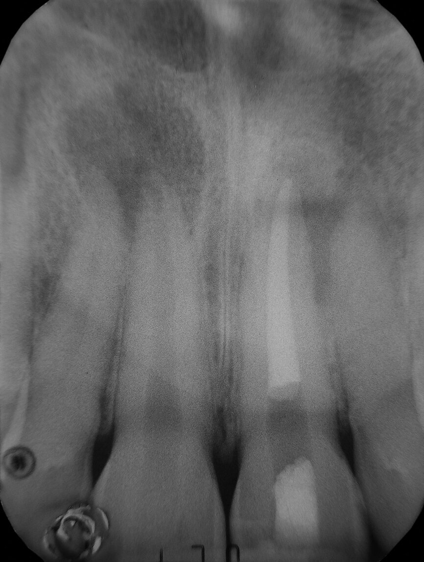 Fig. 3: Post-operative radiograph.