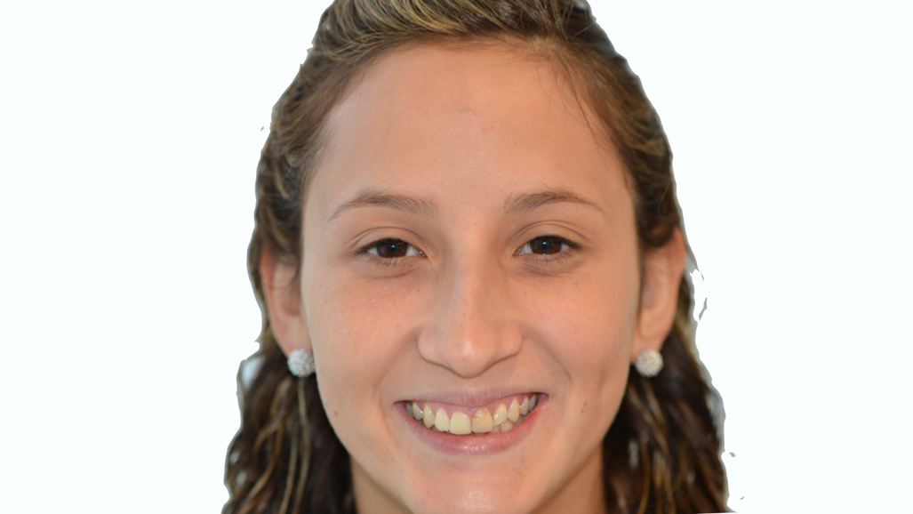 Diseño digital de la sonrisa con composites