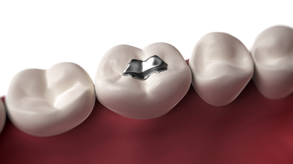 Komplettes Amalgamverbot nicht angestrebt