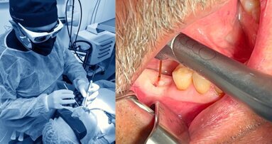 El láser en Implantología (5) El láser en Implantología (5)