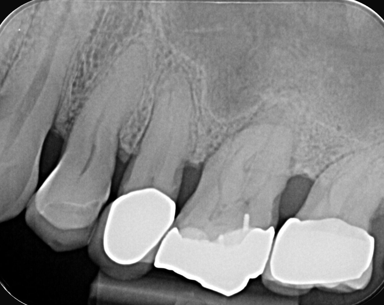 Fig. 7: Pre-op radiograph showing a maxillary first molar with a very calcified pulp chamber and narrow canals.