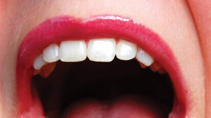 For jaw cancer patients, in-house 3-D printing allows quicker restoration of teeth