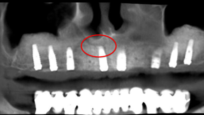 Il Canalis Sinuosus: una struttura anatomica da conoscere e rispettare