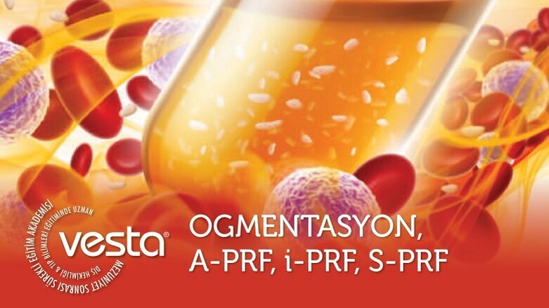 Ogmentasyon, A-PRF, i-PRF, S-PRF