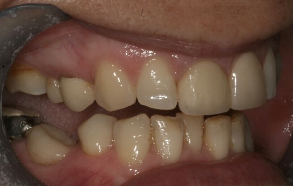 Fig. 5: 2004—lateral view of the initial clinical situation.