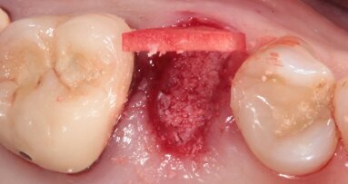 Socket preservation con acido ialuronico reticolato e riabilitazione impianto supportata di un secondo premolare superiore