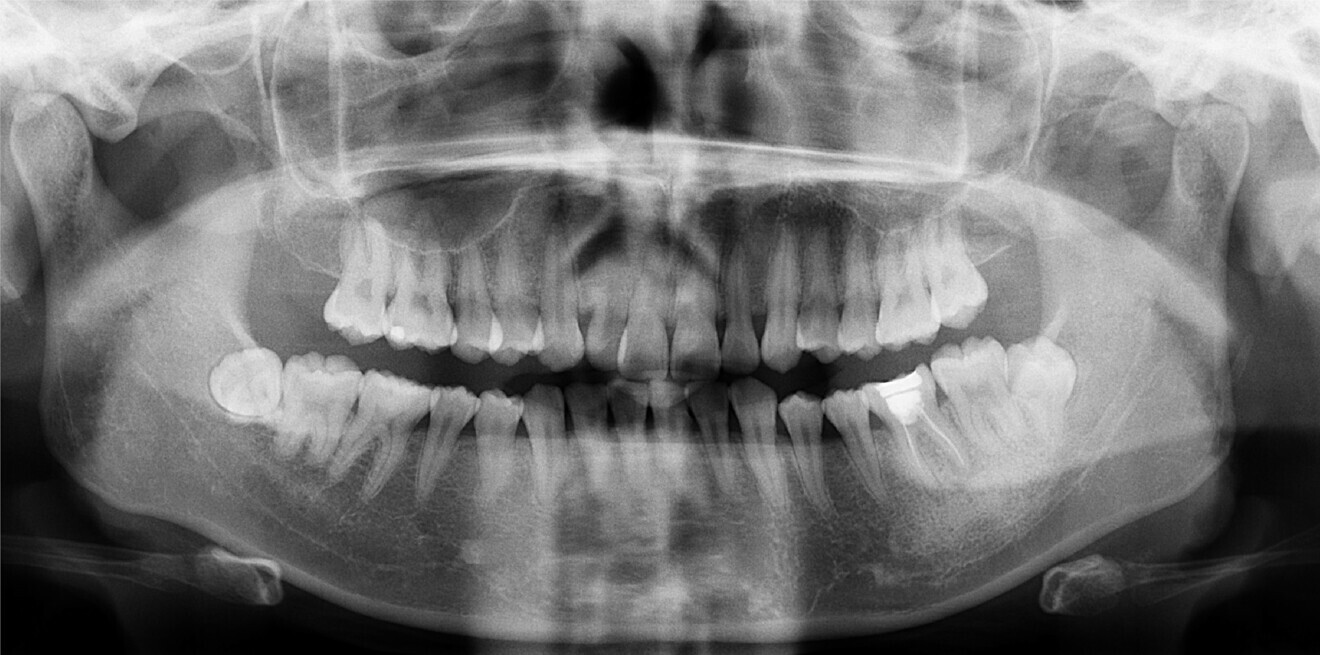 Fig. 2b: Dental panoramic tomogram taken before treatment began. 