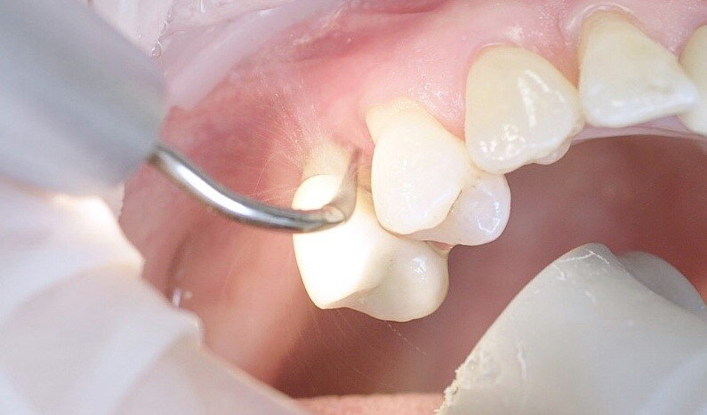 Fig. 3: If marginal periodontitis is diagnosed, the initial debridement can be carried out very efficiently with an air scaler (sonar technology, W&H Proxeo with 1AP tip). (Photograph: W&H)
