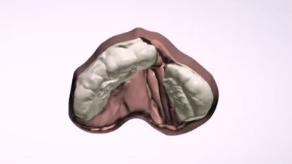 Labio y paladar fisurado Luna video6a