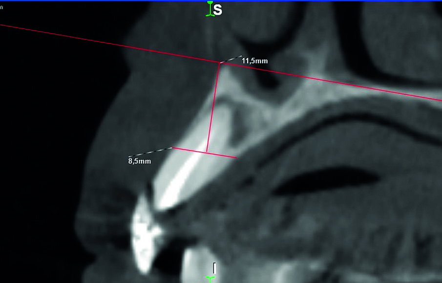 Fig. 2_Dettaglio CBCT (è mostrato l’elemento 1.2), esemplificativo dello spessore estremamente ridotto della corticale vestibolare della paziente, al limite della rilevabilità dell’esame diagnostico.