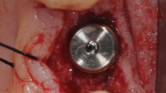 Valutazione istologica della preservazione di cresta alveolare: tecnica con lembo e tecnica flapless a confronto