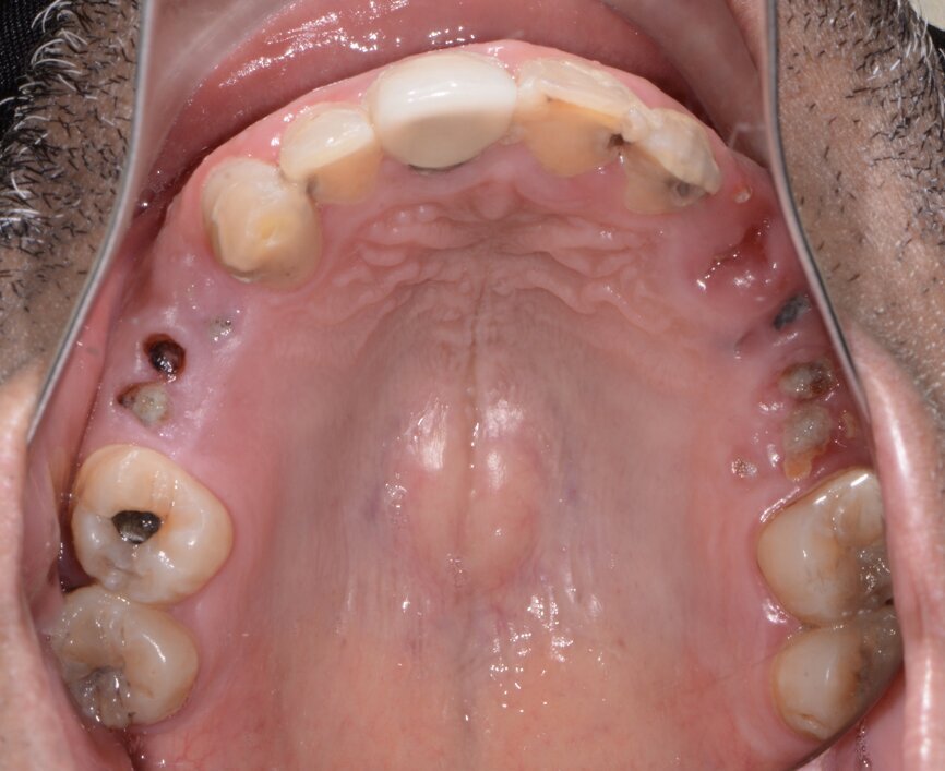 Fig. 2: Pre-op maxillary occlusal view.