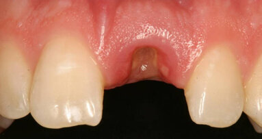 Management of a single implant in the esthetic zone