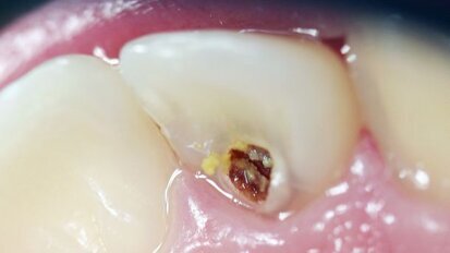 “Houd voorstadia van cariës goed in de gaten”