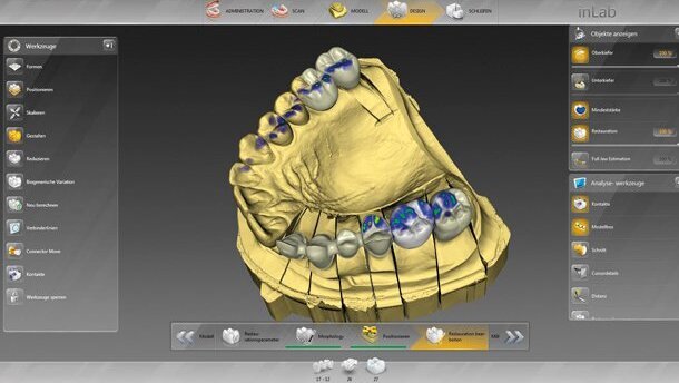 Sirona – Il software inLab, completamente rivisitato, offre una libertà straordinaria