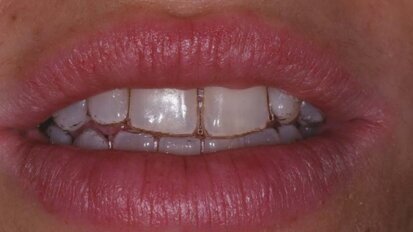 Protocolli di igiene orale per la bellezza e la salute del sorriso nel paziente ortodontico