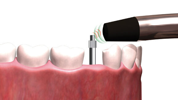 25 years of assessing osseointegration through ISQ diagnostics