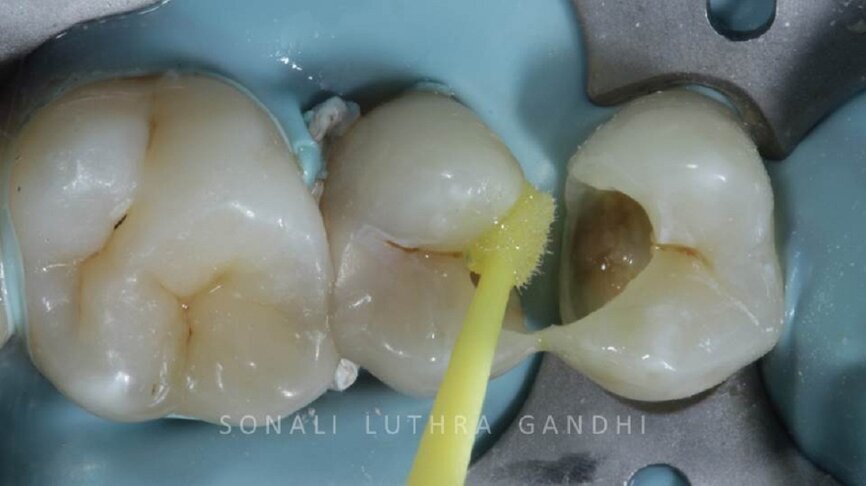 Figure 6 Application of Self etch Bond