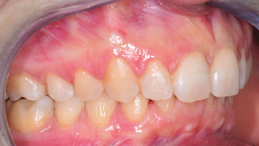 Figg. 8d-8f_Foto intraorali di fine trattamento.