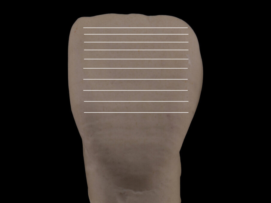 Fig. 8: The horizontal lines make the tooth appear wider, and there is a progressive expansion of the shape connected to the length of the lines and the distance between them.