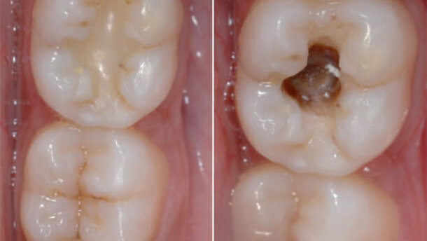 Replacement of a faulty posterior restoration