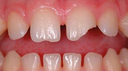 Case report. Restauro diretto multi shade con Filtek™ Supreme XTE