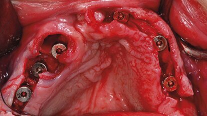 Implantološka rehabilitacija pacijenata sa rascepom