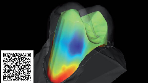 Vedci vyvíjajú softvér na zlepšenie nasadenia koruniek na zuby
