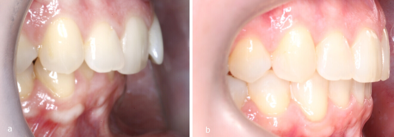 Figs. 9a & b: Overjet before and after the treatment.