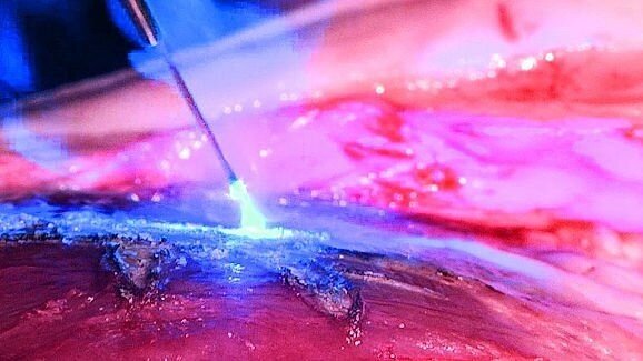 Markt voor lasertandheelkunde groeit gestaag