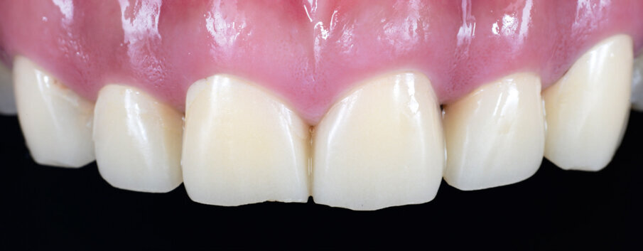 Fig. 4: Provisional composite resin restorations for evaluating their function and aesthetics