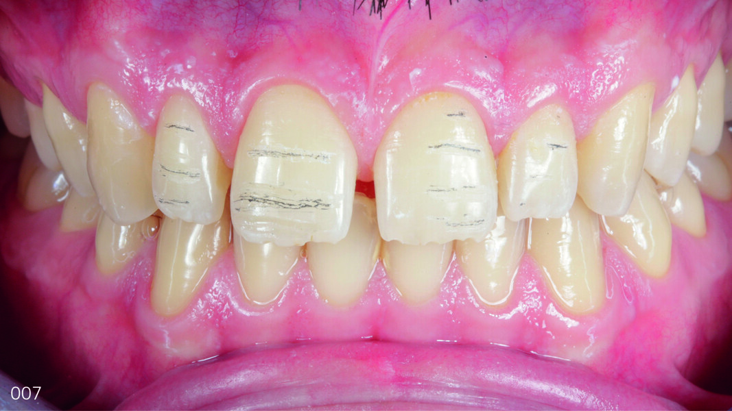 Fig. 7: Mock-up removed with pencil marks where the preparation would continue directly on the tooth (sacricing the mock-up spared healthy hard tissue).