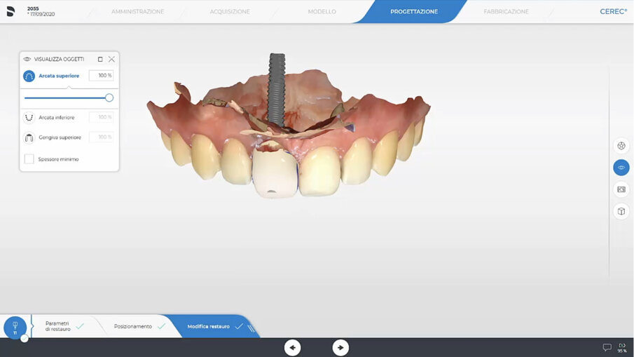 Fig. 26_Il software CEREC elabora le informazioni e crea il dente definitivo.