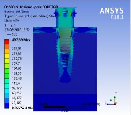 Fig. 9c - Von Mises results of the complex bone fixture and prosthodontics attachments, OT Equator prosthesis.