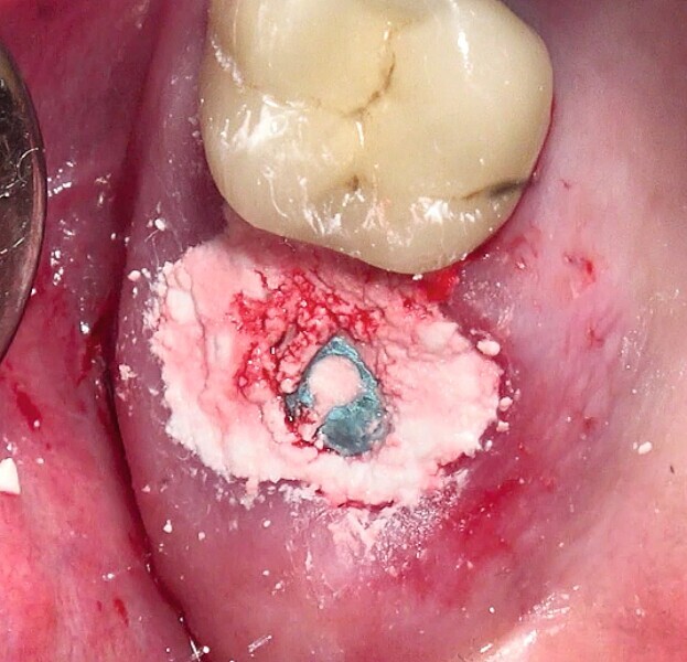 Fig. 54 : Allogreffe constituée d’un substitut osseux et ciment de protection au sulfate de calcium biphasique. 