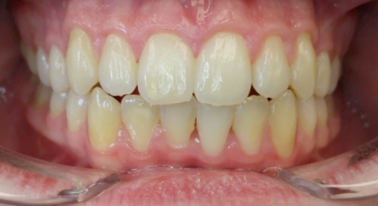 Fig. 10: Movement achieved after seven months without attachments.