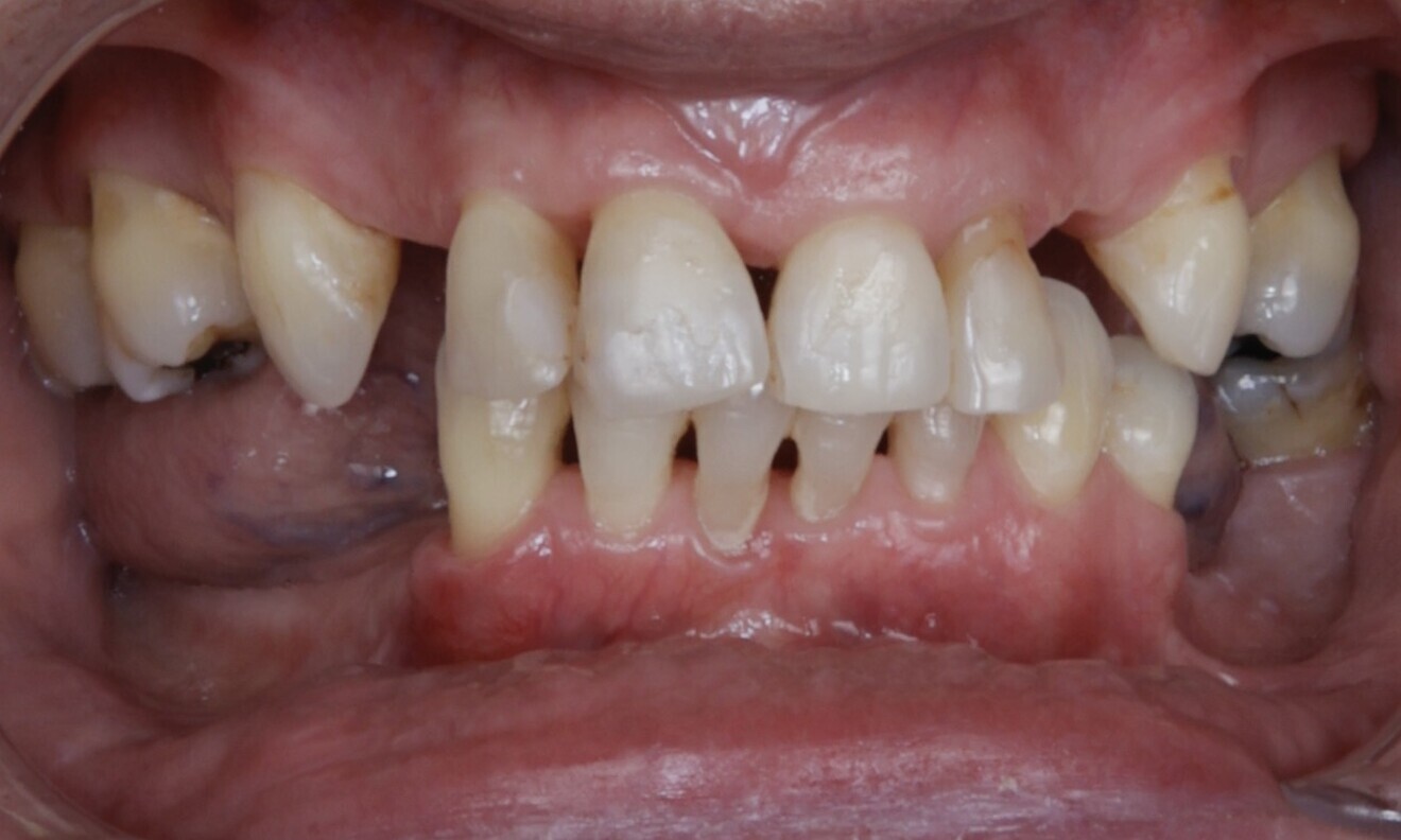 Figs. 4–7: The intra-oral examination showed generalised periodontitis, a removable maxillary restoration and multiple missing mandibular and maxillary teeth.