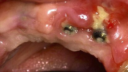 El rol del odontólogo en la osteonecrosis maxilar provocada por anticuerpos monoclonales
