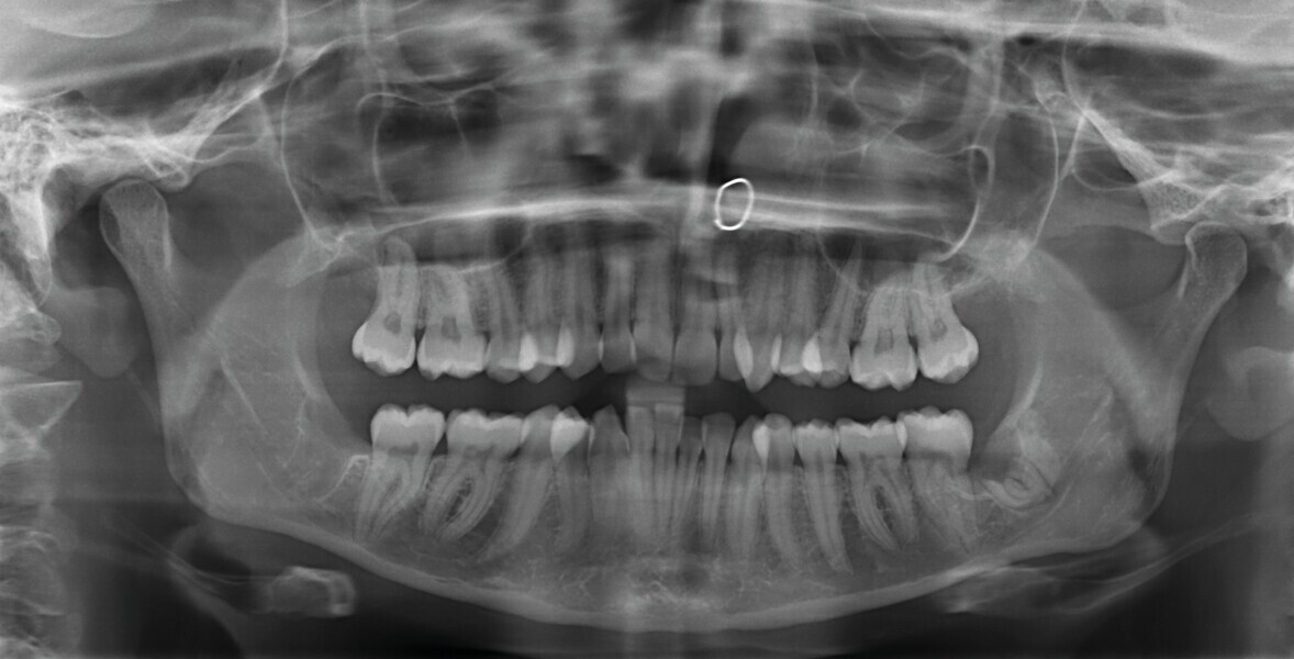 Fig. 2 : Radiographie panoramique initiale.