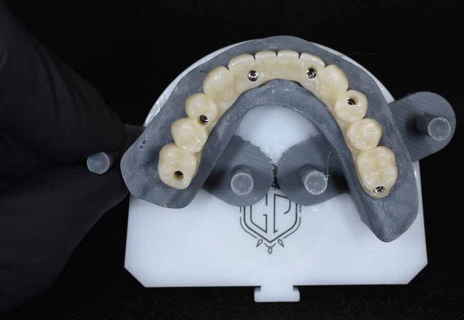 Fig. 17 - Visione occlusale del provvisorio.